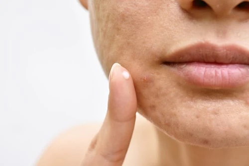 Homeopathic solutions for Acne Skin Care